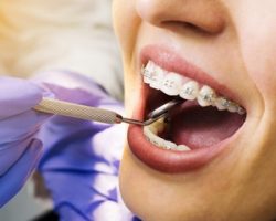 Как лечить зубочелюстные аномалии?